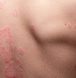 Psoriasis Vulgaris, skin patches are typically red, itchy, and scaly. Papules of chronic psoriasis vulgaris on male hand, back and body. Genetic immune disease. Detail of psoriatic skin disease