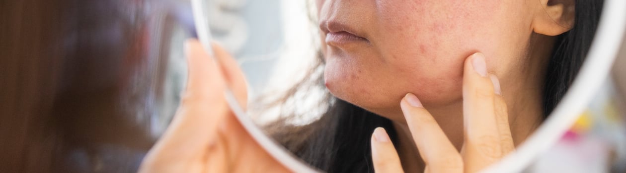 rosacea awareness month