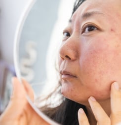 rosacea awareness month