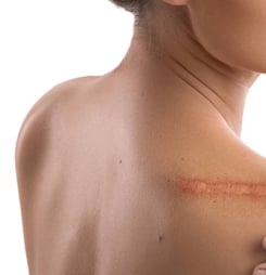 scar appreciation day