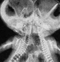 world conjoined twins