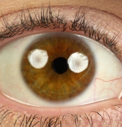 world keratoconus day